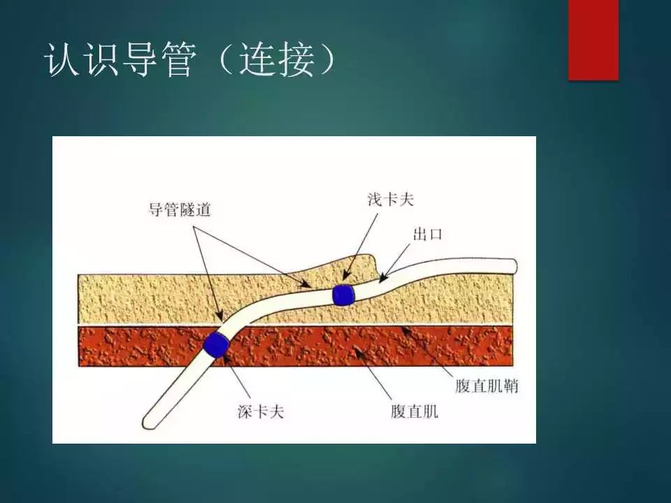 腹膜透析置管位置图片