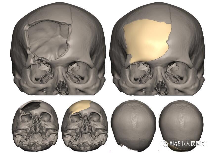 醫療動態│新材料新技術治療複雜性顱骨缺損患者
