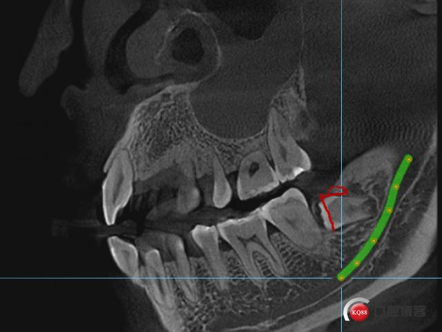 舌侧骨板位置图片