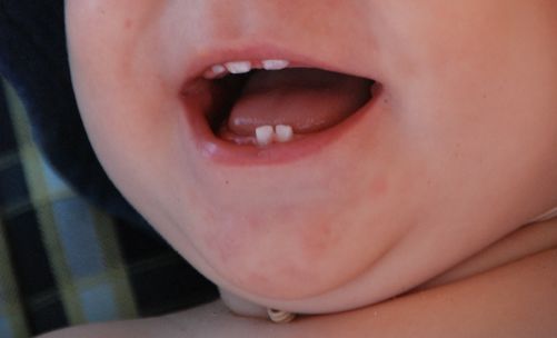 宝宝长牙的症状图片
