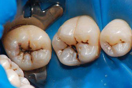 出现黑色物质,这说明你的牙齿已经遭受细菌腐蚀,已经到达缺损阶段了