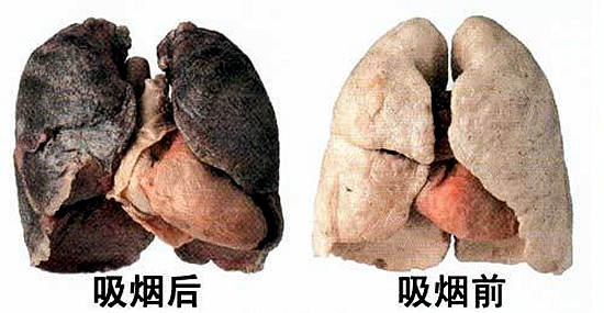 吸烟者的肺真实图片