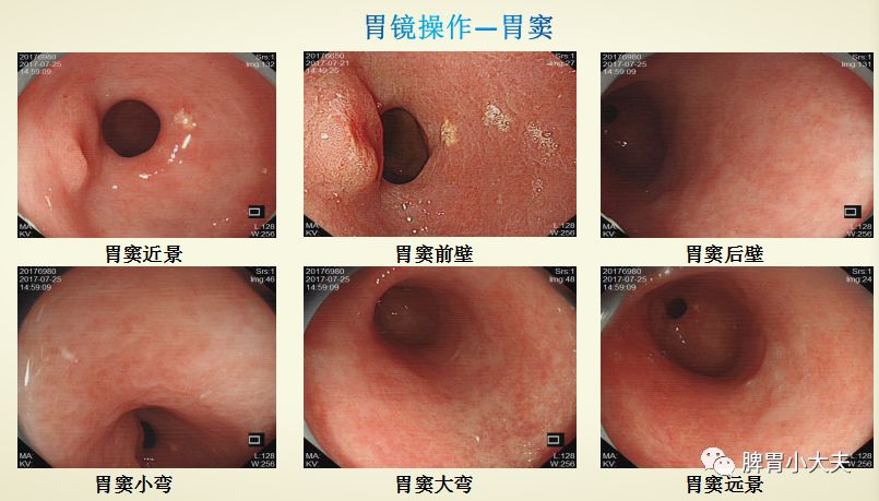 胃窦胃镜图片图片