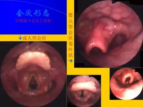 咽喉镜图片正常人图片图片