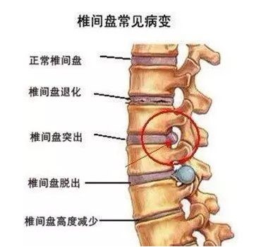 腰间盘突出示意图片图片