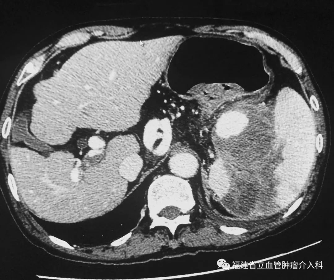 的血液不斷滲出另外可見類似