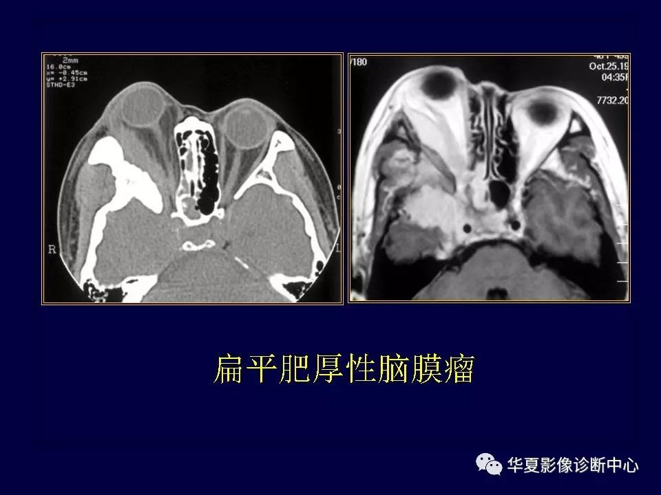 眼眶解剖基礎與影像學定位診斷