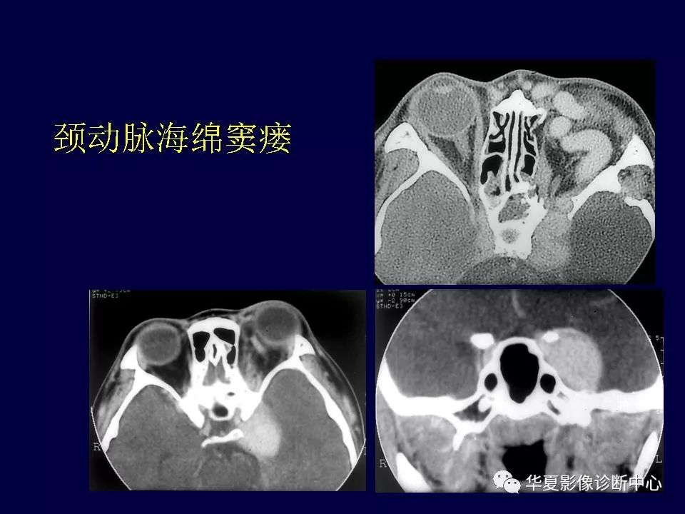 眼眶解剖基礎與影像學定位診斷