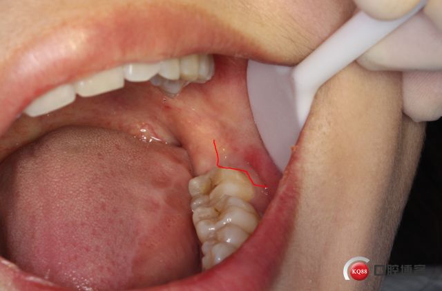 阻生牙翻瓣切口图片