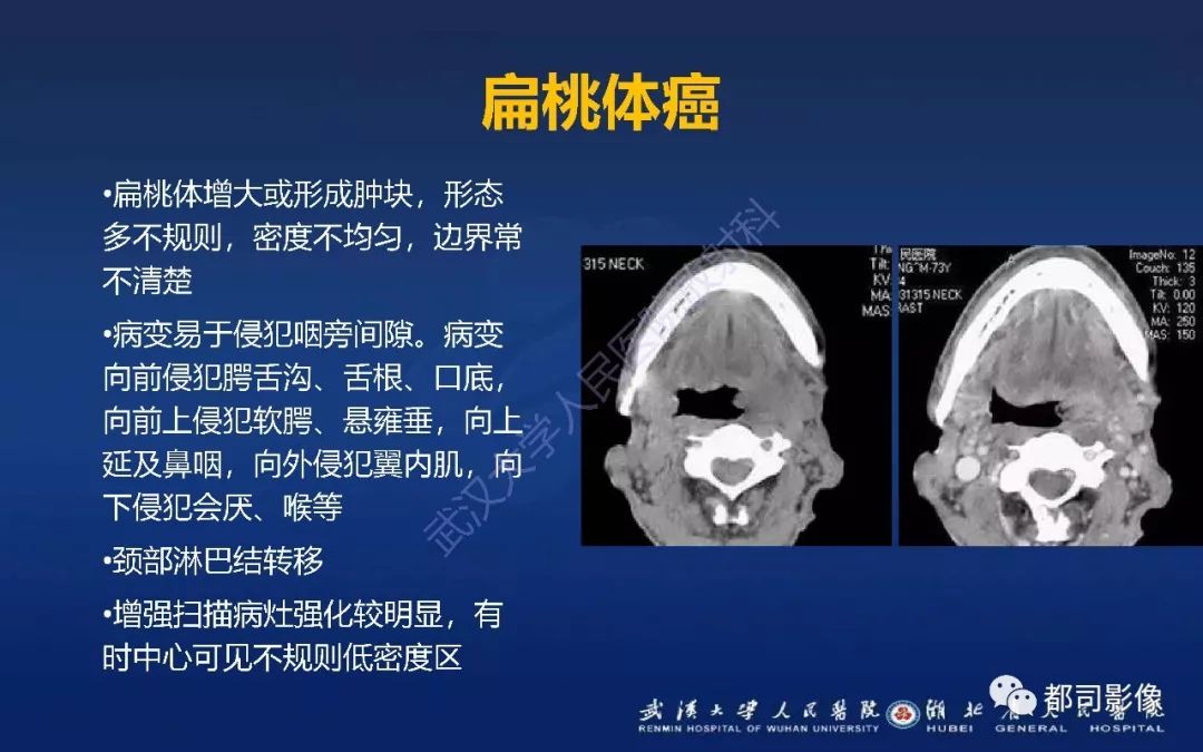 软腭乳头状瘤图片图片