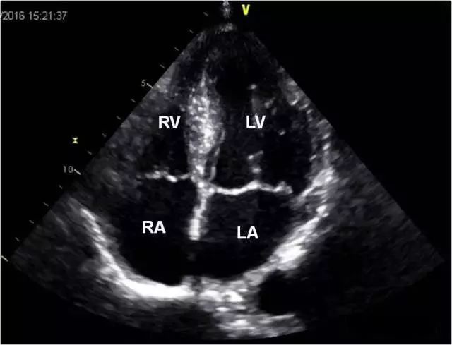 心脏彩超四腔心解剖图图片