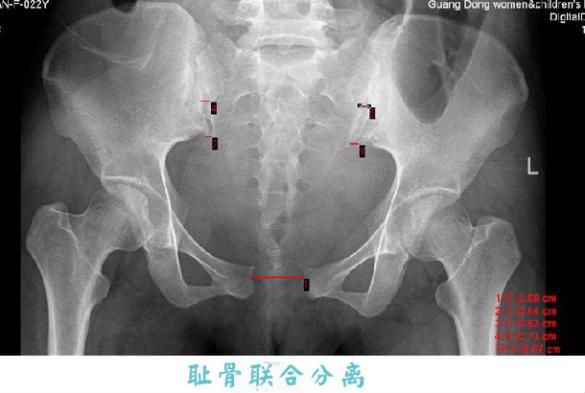 妈妈产后耻骨痛,怎么破?