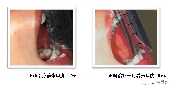 张口受限一度二度三度图片