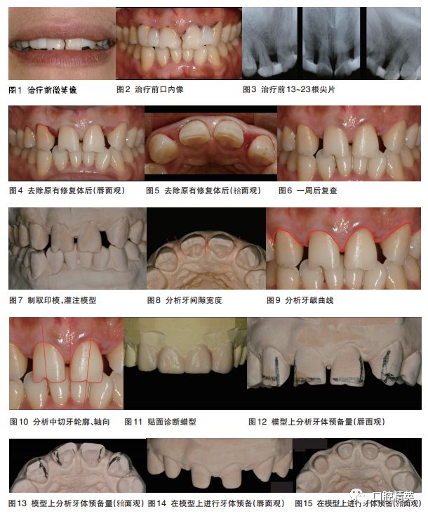 上前牙全瓷固定橋美學修復一例