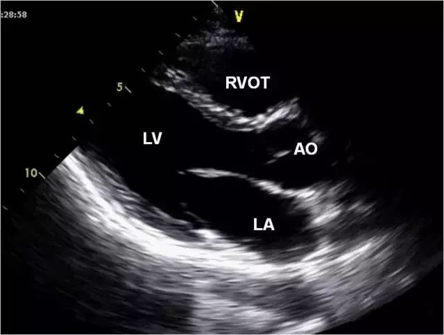 二维心超常用切面及容易忽视的细节