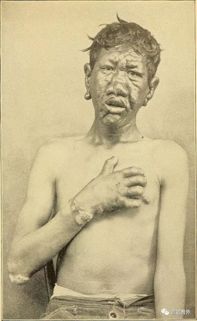 古代麻风病图片