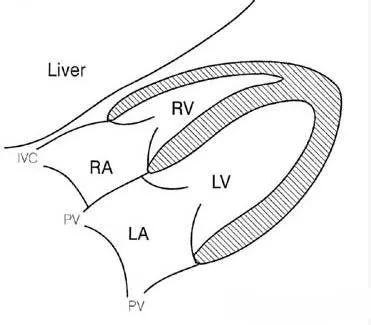 右室流入道切面图解图片