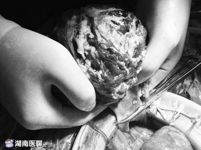 30岁女子腹部凸起如怀胎十月手术机会渺茫哀求救她一命