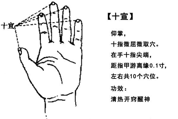 中频治疗偏瘫位置图解图片