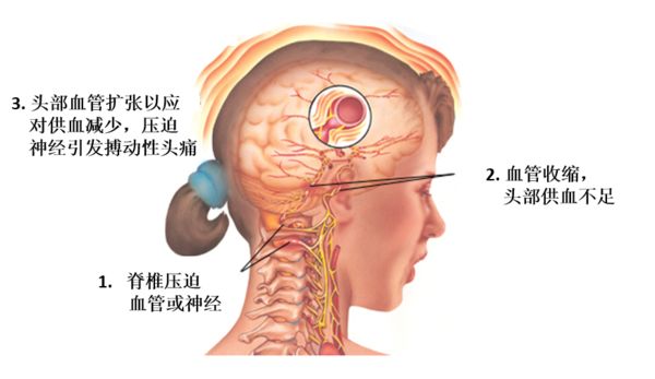 颈交感神经节压迫图片