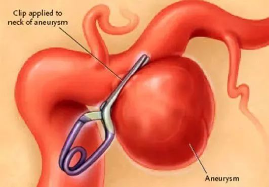 手術視頻天壇醫院北大國際趙元立降低動脈瘤夾閉術後複發率和功能障礙