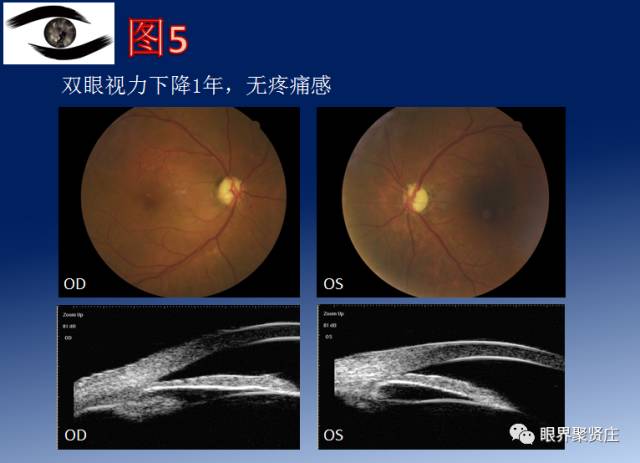 正常眼壓性青光眼(ntg)圖中可見,左眼典型的青光眼性視野缺損(上方