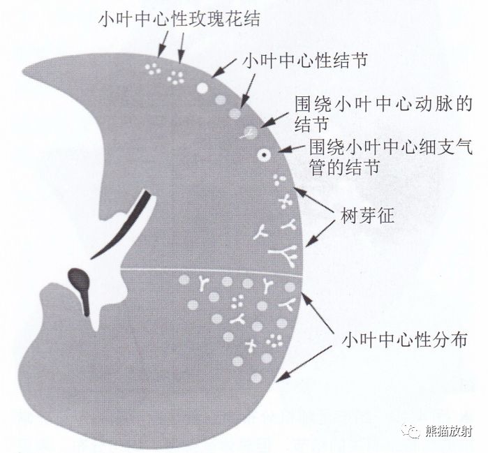 小叶中心结节示意图图片