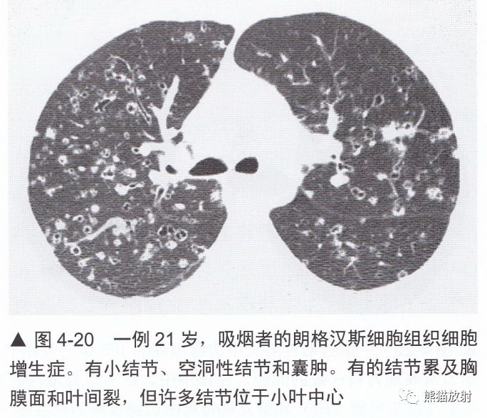 矽肺 ↓ ↓癌性淋巴管炎 ↓ ↓上述內容整理自《高分辨率肺部ct