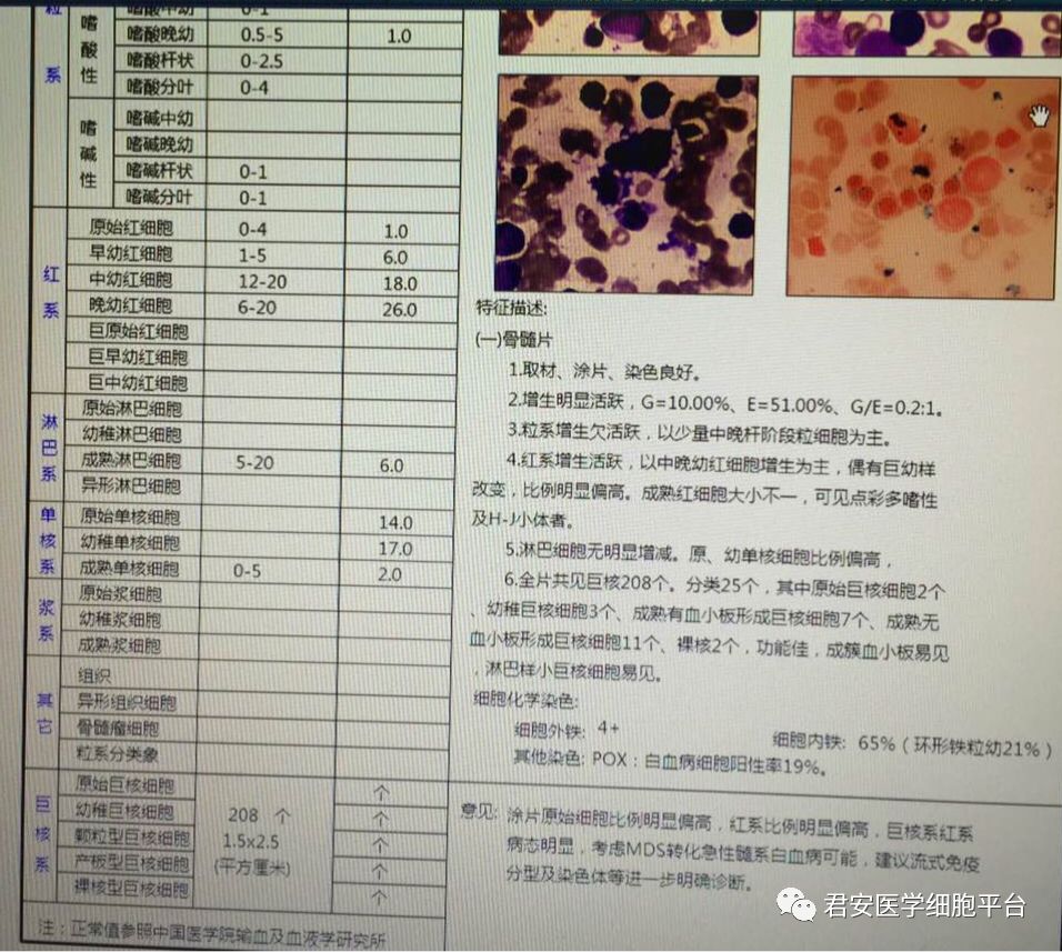骨髓报告意见涂片原始细胞比例明显偏高,红系比例明显偏高,巨核系红系