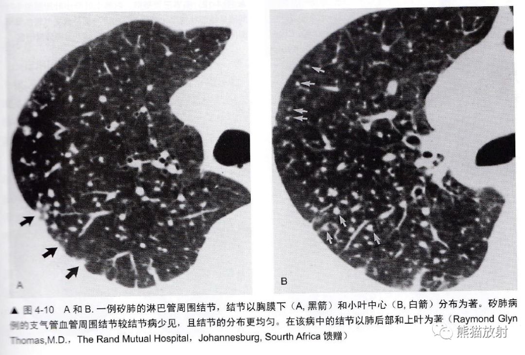 知识点丨肺多发结节之概念与评估