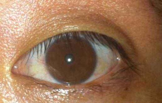 肝病眼睛图片
