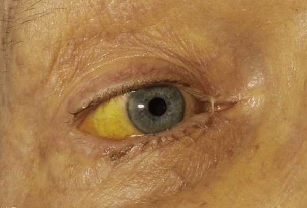 眼睛怎么黄才算是黄疸图片