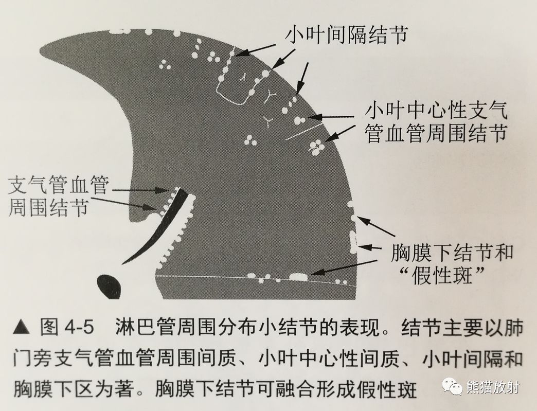 隱源性機化性肺炎 ↓淋巴樣間質性肺炎 ↓結節病 ↓ ↓矽肺