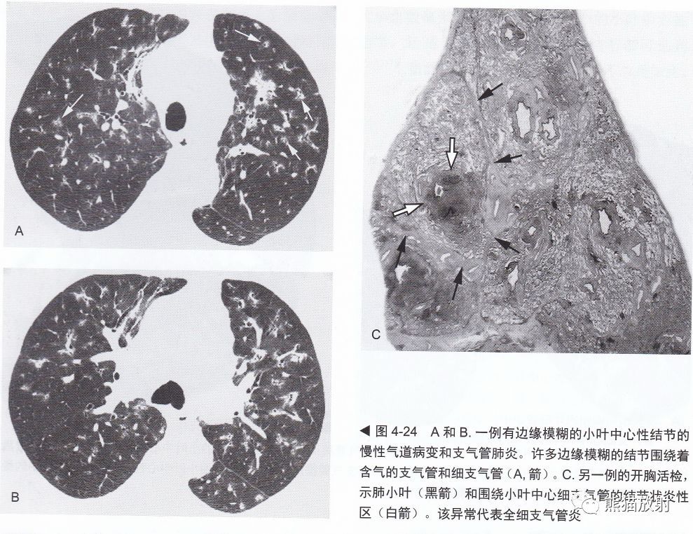 矽肺 ↓ ↓癌性淋巴管炎 ↓ ↓上述內容整理自《高分辨率肺部ct