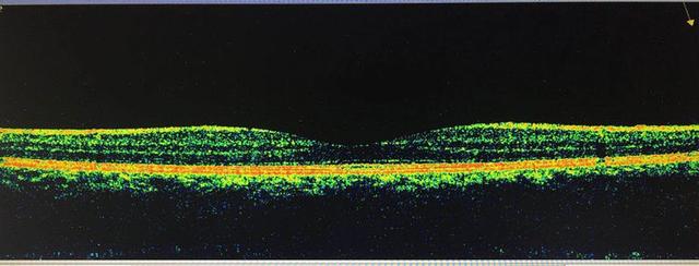 下面是一張正常的視網膜黃斑中心凹的oct圖像,也就是黃斑區的斷層掃描