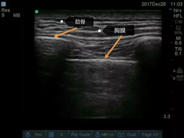 如何從零開始學習超聲引導下神經阻滯?這篇文章你不可錯過
