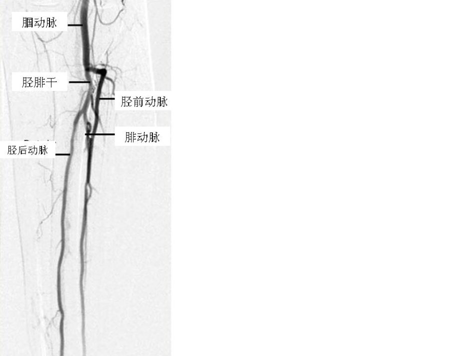 图解四肢血管造影dsa及介入操作规范