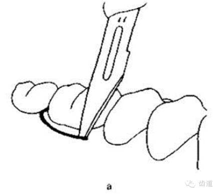 下颌阻生牙的切口设计图片