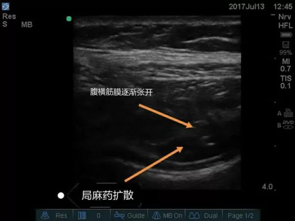 超声引导下髂筋膜阻滞图片