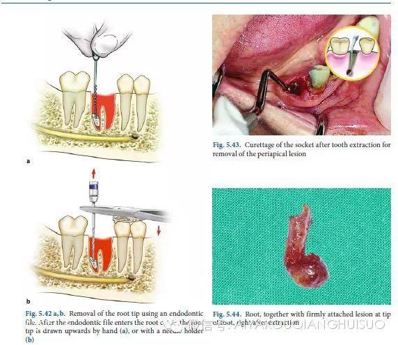 精美拔牙图谱(每位牙医都要珍藏!