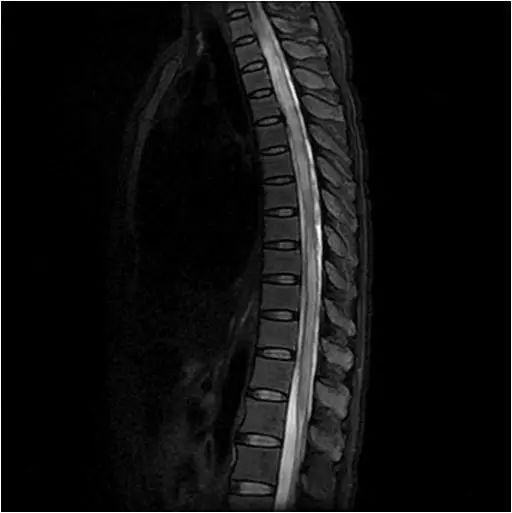 脊髓炎核磁共振图片