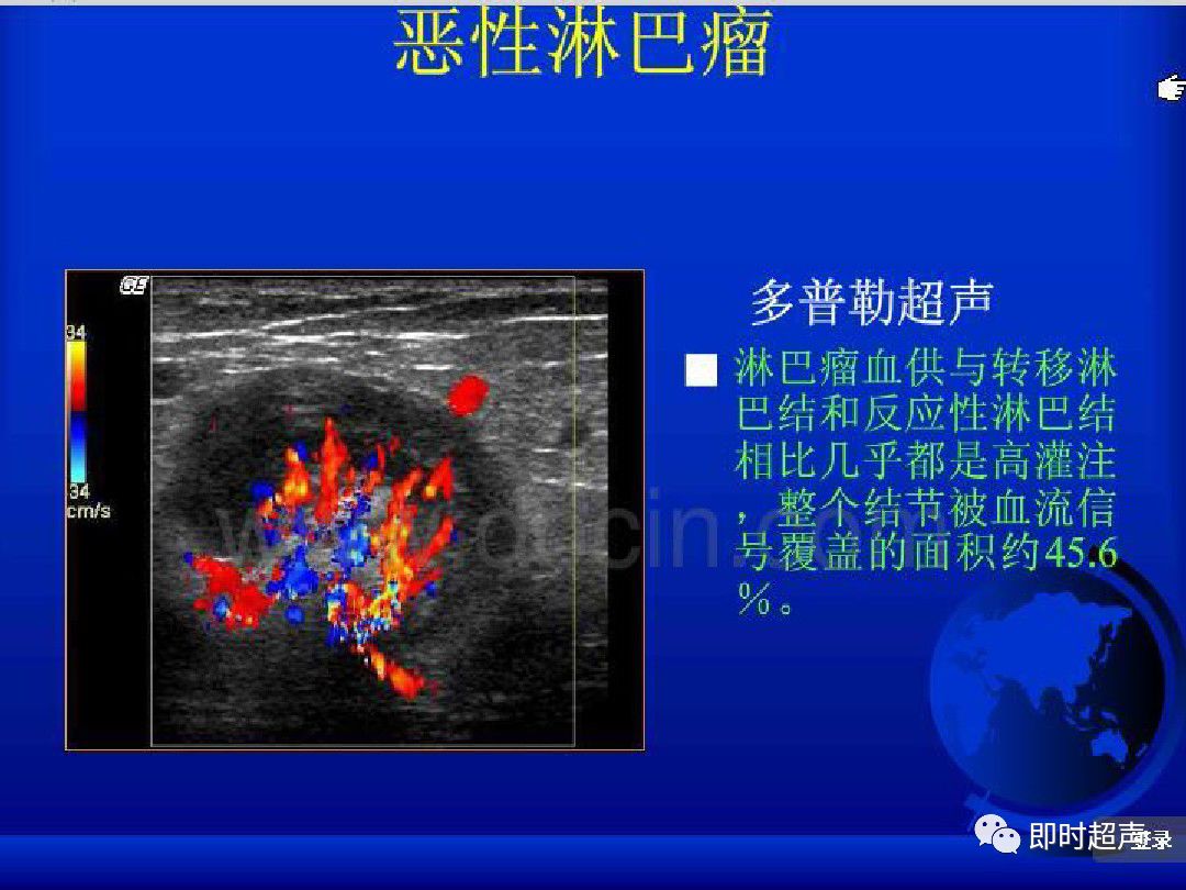 淋巴结炎彩超图片