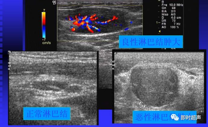 淋巴结肿大的超声诊断