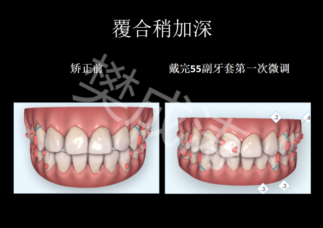 隐形牙套 种植钉图片