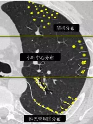 二,次級肺小葉的解剖及小結節分佈示意圖④隨機型;hrct上根據小結節與