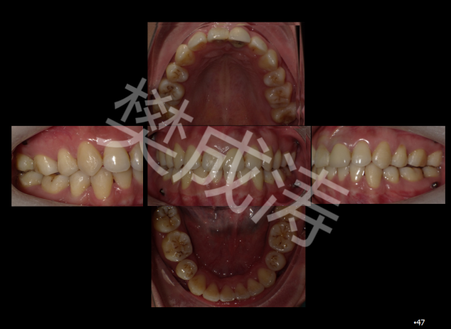 樊成濤醫生拔下頜前磨牙推上頜磨牙向遠中隱形矯正