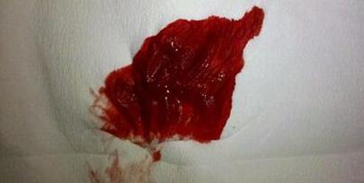 痔疮便血的颜色的比较鲜红的,血是附在大便的表面,排便的时候有严重的