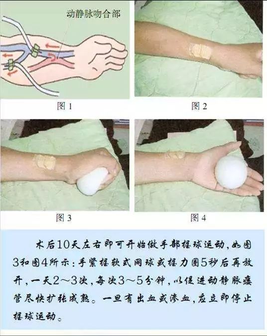 动静脉内瘘的日常护理