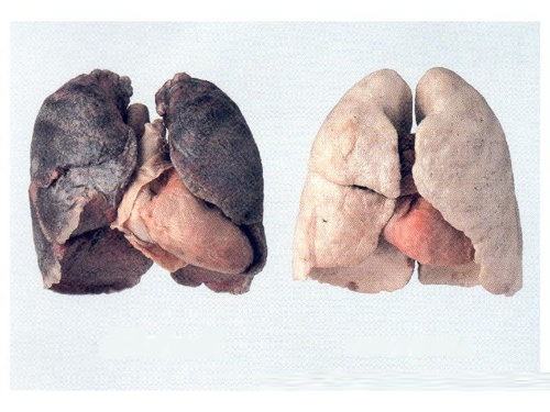 一期尘肺图片 轻微图片