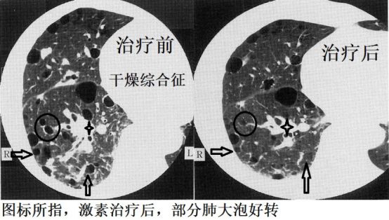 關於肺大泡你不知道的事:藥物治療好轉的肺大泡和急性肺大泡